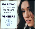 15 Questions to ask before getting veneers